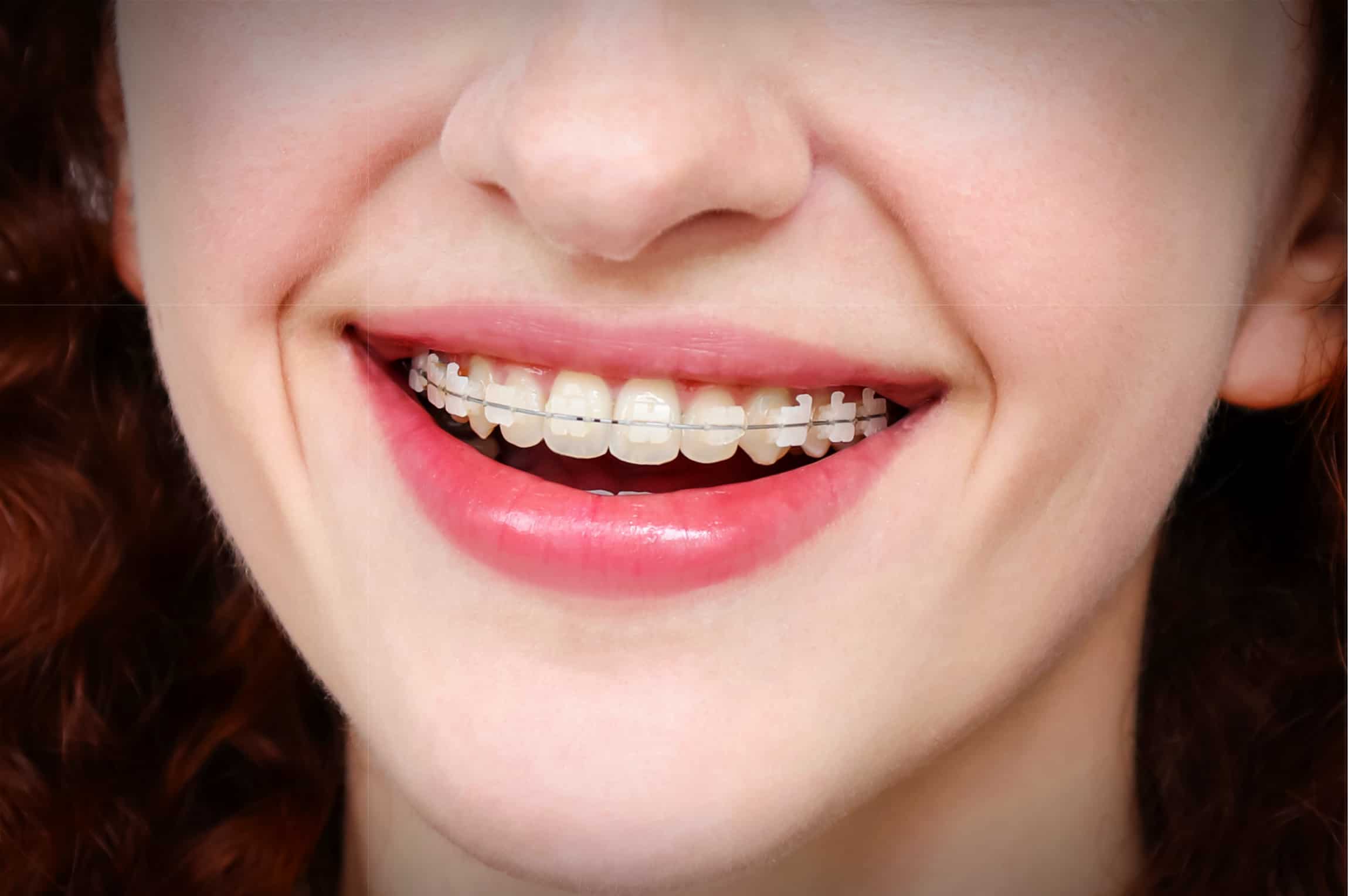 clear dental braces are one of our orthodontic services