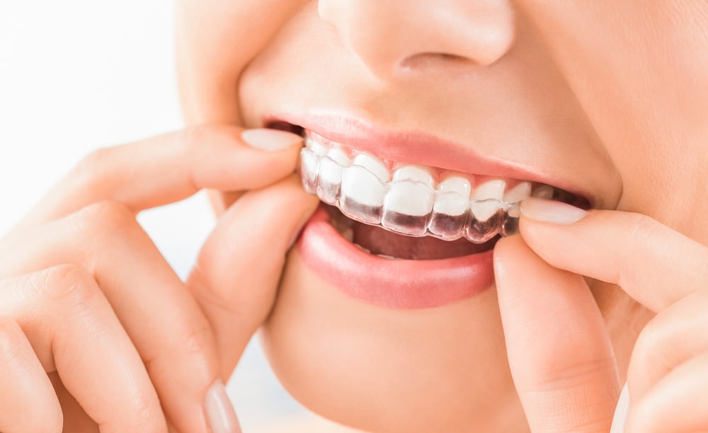invisalign orthodontic services