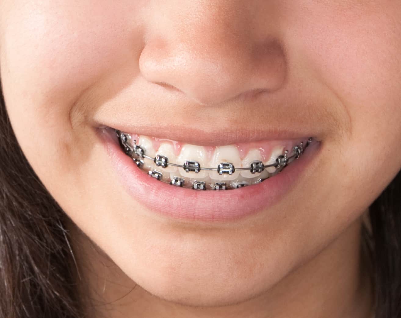 metal braces are part of our orthodontic services at Prestige Orthodontics